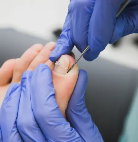 tratamento de unha encravada em joinville clinica de podologia